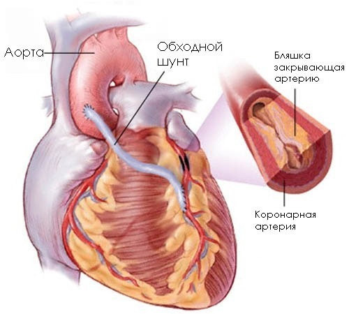 Аортокоронарное шунтирование сосудов сердца: суть операции