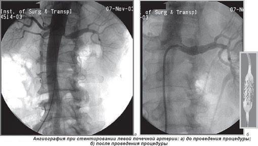 Что такое реноваскулярная (вазоренальная) артериальная гипертензия: особенности лечения