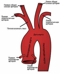Атеросклероз брахиоцефальных артерий: что это, симптомы, лечение, стенозирующий и нестенозирующий, поражение бца внечерепных отделов