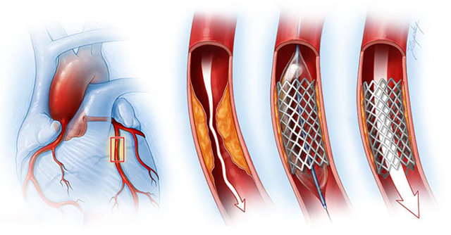 Особенности операции стентирования сосудов сердца и период реабилитации
