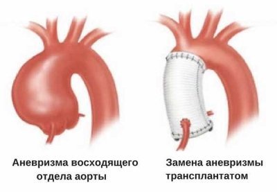Расширение восходящего отдела аорты сердца