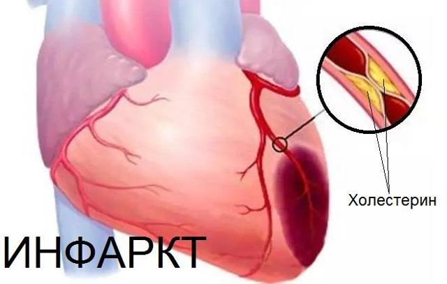 Последствия высокого артериального давления: какую угрозу организму несет гипертония