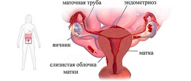Высокое давление после родов: причины гипертонии