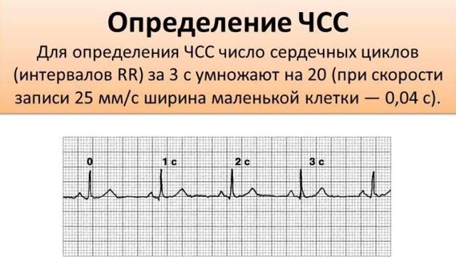 Кардиограмма сердца: как расшифровать ее самостоятельно, пример плохой электрокардиограммы у женщин