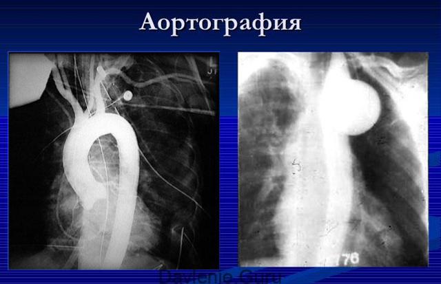 Нестенозирующий атеросклероз: эхографические и другие признаки патологии, поражение артерий нижних конечностей