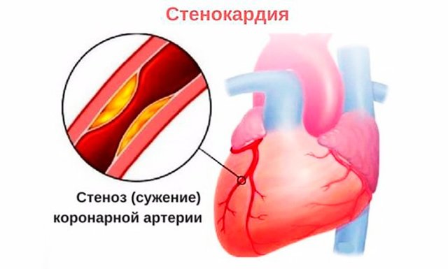 Симптомы спазма коронарных сосудов сердца