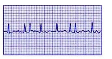 Радиочастотная абляция сердца, ее последствия, особенности реабилитации