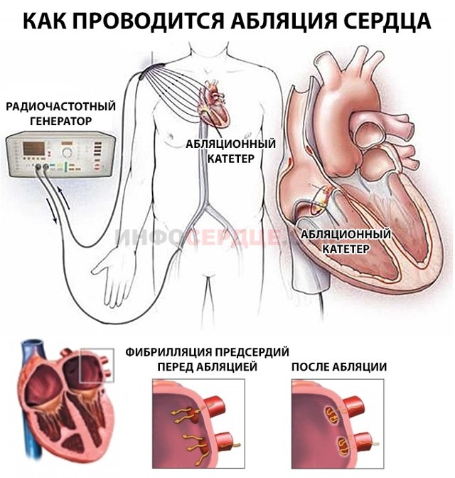 Желудочковая аритмия сердца: лечение