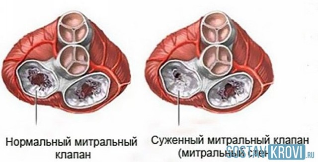 Стеноз митрального клапана: что это такое, классификация, гемодинамика, симптомы и лечение
