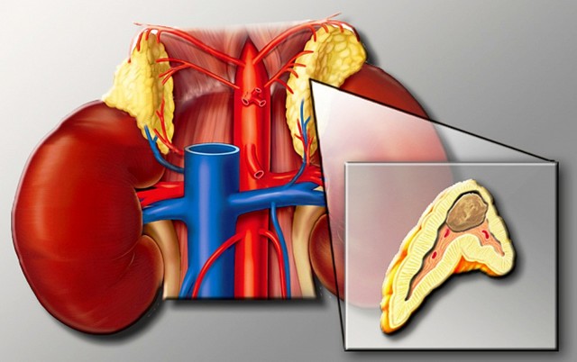 Стадии артериальной гипертензии: классификация и таблица