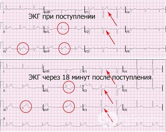 Признаки инфаркта миокрада на ЭКГ