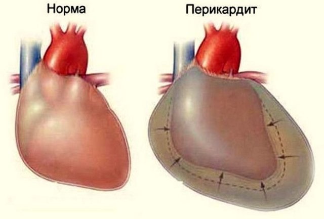 Жидкость в сердце после операции: что это такое, симптомы и лечение