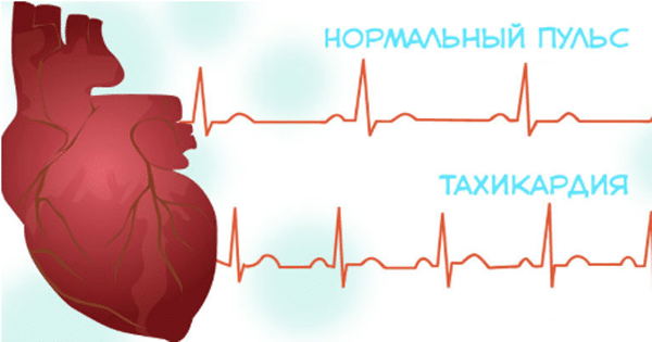 Учащенное сердцебиение: причины и лекарства, что принять
