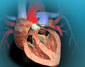 Порок сердца операция: сколько стоит