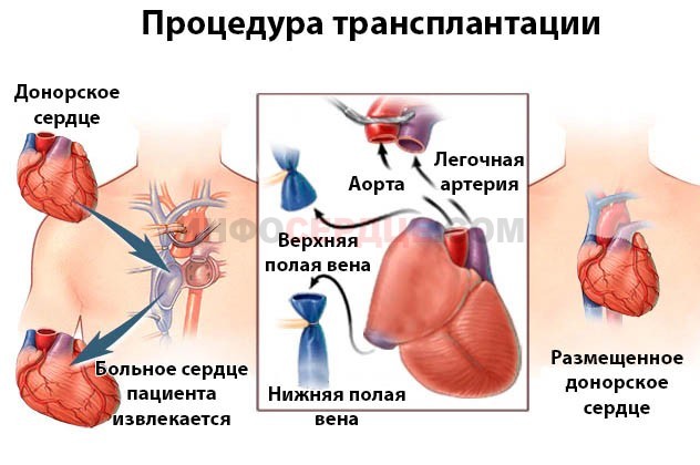 Пересадка сердца: как делают, стоимость в России, продолжительность жизни