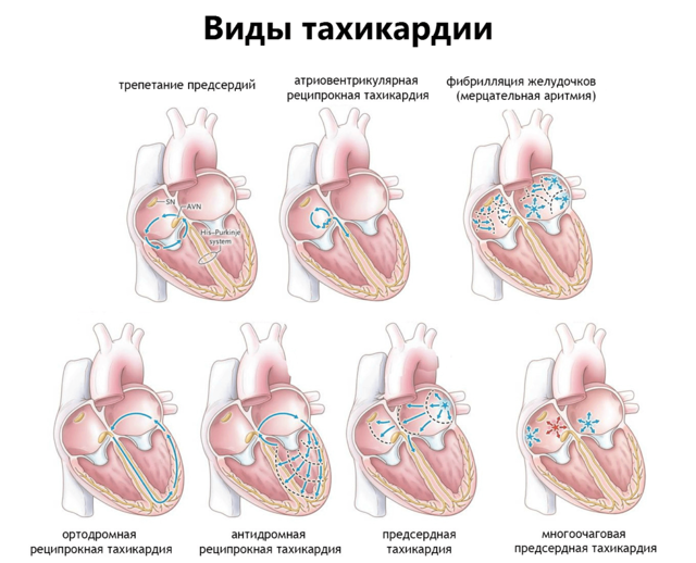 Тахикардия сердца: что это такое, признаки, симптомы и лечение