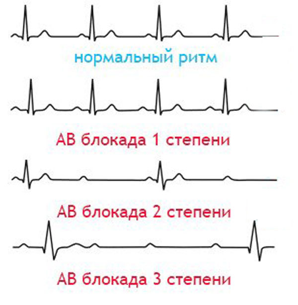 Нарушение проводимости сердца, блокада 1 степени: что это такое простыми словами, симптомы, причины, лечение и экг