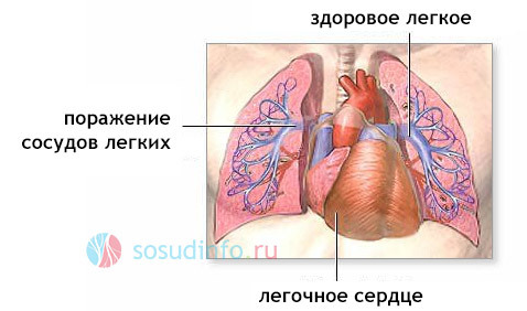 Легочное сердце: что это такое, симптомы и лечение, прогноз и рекомендации