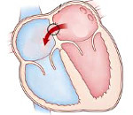 Дефект межпредсердной перегородки: вторичный врожденный порок сердца у новорожденных детей и взрослых