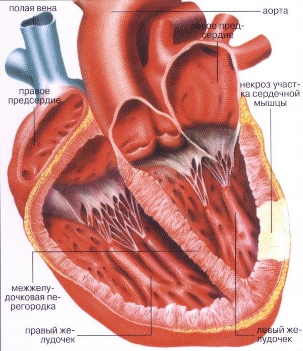 гипертония миокарда левого желудочка сердца