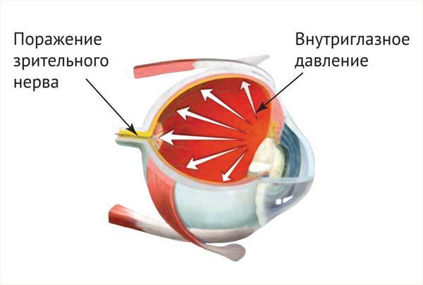 Глазное давление: причины, симптомы и лечение таблетками
