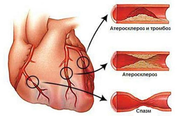 Предынфарктное состояние у женщин и мужчин: симптомы и признаки, как определить, лечение в стационаре