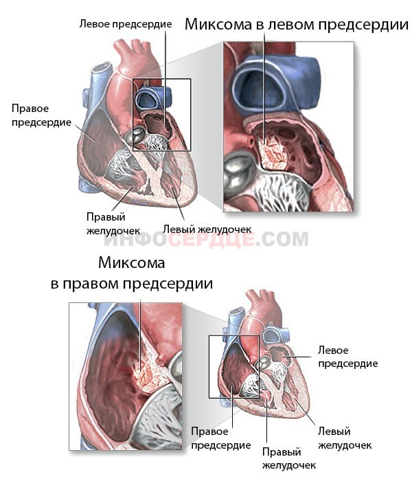 От левого предсердия к легким. Миксома левого предсердия операция. Доброкачественная опухоль сердца миксома. Миксома правого желудочка. Миксома сердца клинические рекомендации.