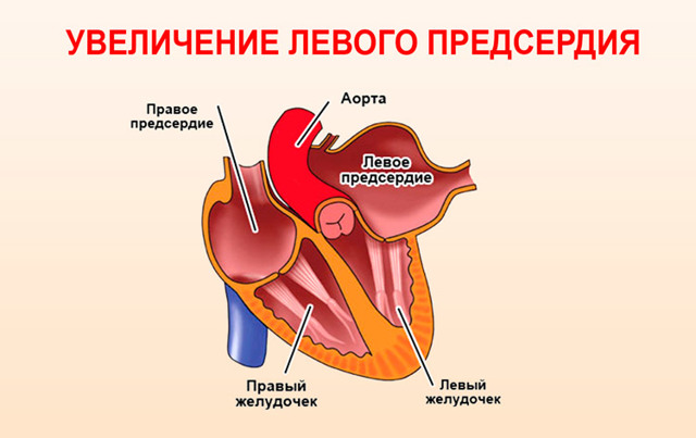 Дилатация полости левого предсердия, правых и левых отделов сердца: что это такое