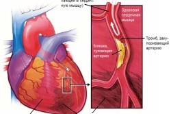 Профилактика инфаркта миокарда: как его избежать, препараты для мужчин и женщин