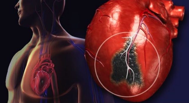 Острый инфаркт миокарда передней стенки левого желудочка на экг: что это значит, прогноз