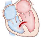 Дефект межжелудочковой перегородки сердца у новорожденного