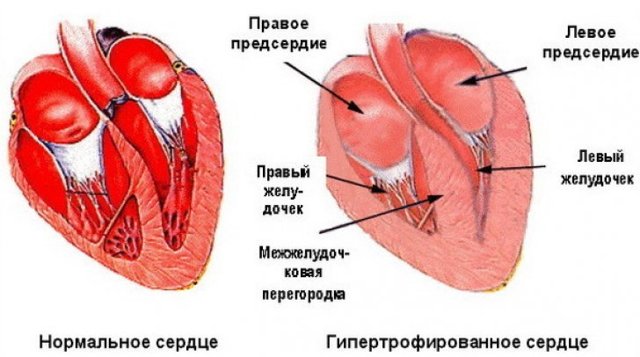 Увеличение левого желудочка сердца: что это такое, причины, лечение и последствия