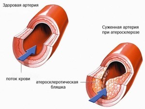 Фиброз, уплотнение створок аортального и митрального клапана: что это такое