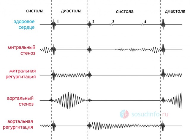 Аускультация сердца: точки выслушивания клапанов у детей, нормы и видео