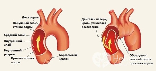Расслаивающая аневризма аорты: симптомы, диагностика и лечение