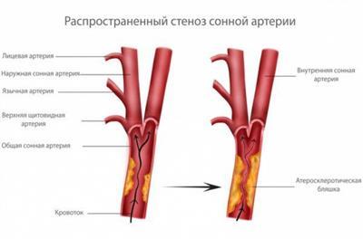 Атеросклероз экстракраниальных сегментов магистральных артерий головы: стенозирующий и нестенозирующий типы