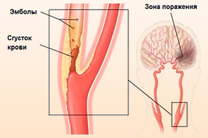 Атеросклероз сосудов шеи: симптомы, лечение, начальная стадия, нестенозирующий тип поражения магистральных артерий шейного отдела