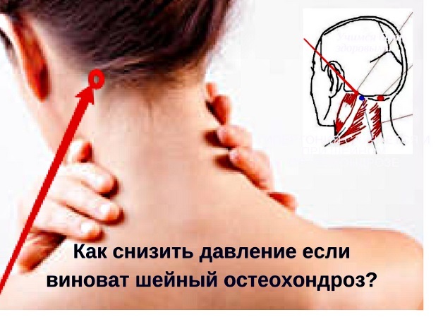 Шейный остеохондроз и артериальное давление