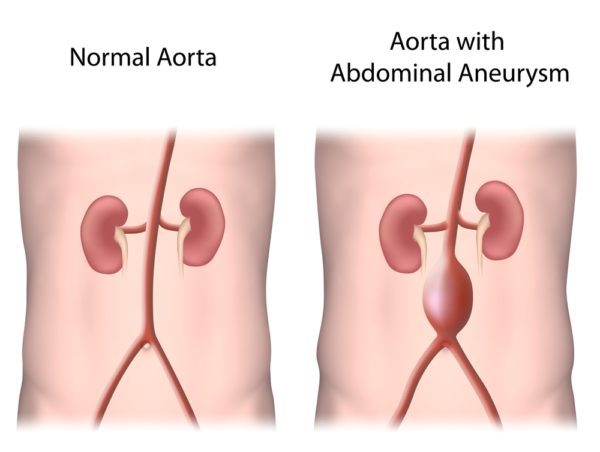 Особенности развития аневризм: строение сосудов и аорт, причины патологии
