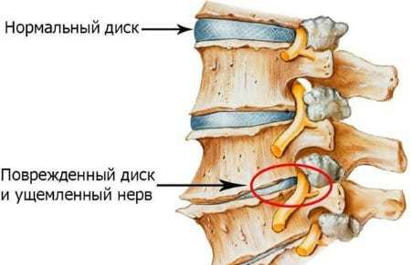Аритмия при остеохондрозе грудного отдела позвоночника