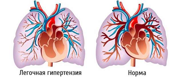 Гипертоническая болезнь, артериальная гипертензия у грудного ребенка, детей до года и подростков