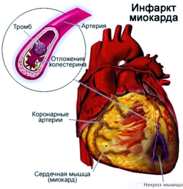 Острый инфаркт миокарда передней стенки левого желудочка на экг: что это значит, прогноз