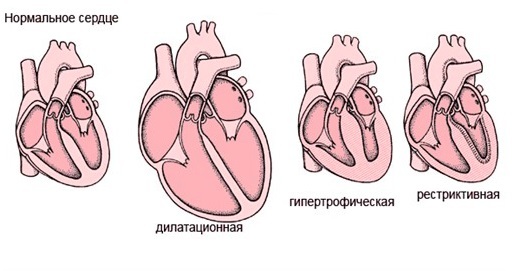 Функциональная кардиопатия у детей: что это такое?