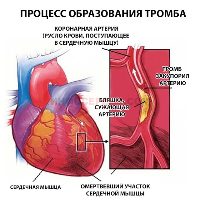 Предынфарктное состояние у женщин и мужчин: симптомы и признаки, как определить, лечение в стационаре