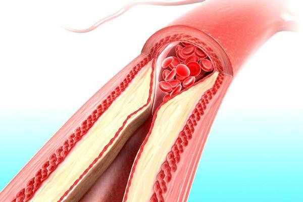 Как влияет цикорий на артериальное давление: повышает или понижает его?