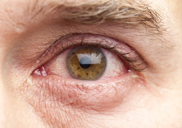 Как снизить глазное давление в домашних условиях: лечение