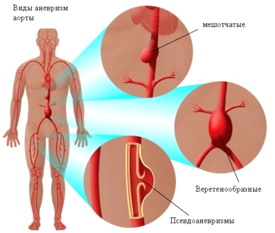 Особенности развития аневризм: строение сосудов и аорт, причины патологии