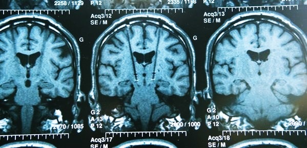 Дистония сосудов головного мозга: симптомы и способы лечения