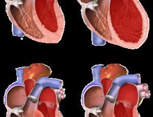 Что такое кардиомиопатия, ее проявления, классификация и причины