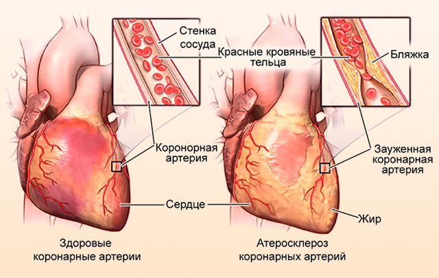 Атеросклеротическая болезнь сердца: что это такое, симптомы поражения, как избавиться от бляшек